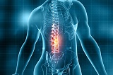 Spinal Neurostimulators